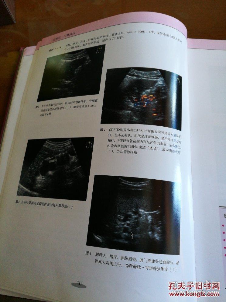 腹部疾病超声图谱