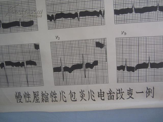 5-60年代 手绘 山东医学院挂图一张 小儿科--慢性压缩性心包炎心电图