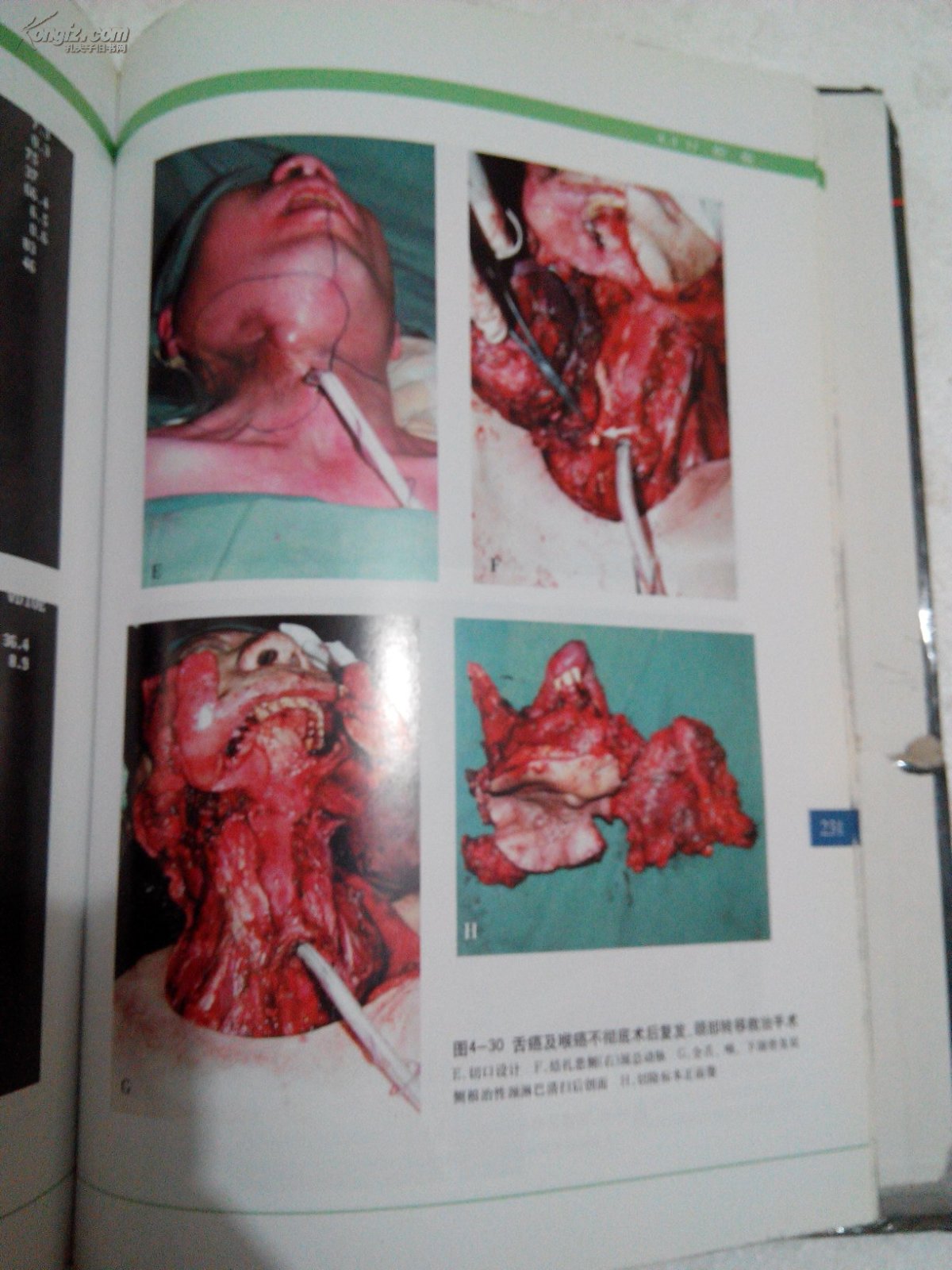 本书内容包括口腔颌面部囊肿,脉管瘤,良性肿瘤和恶性肿瘤的各种手术