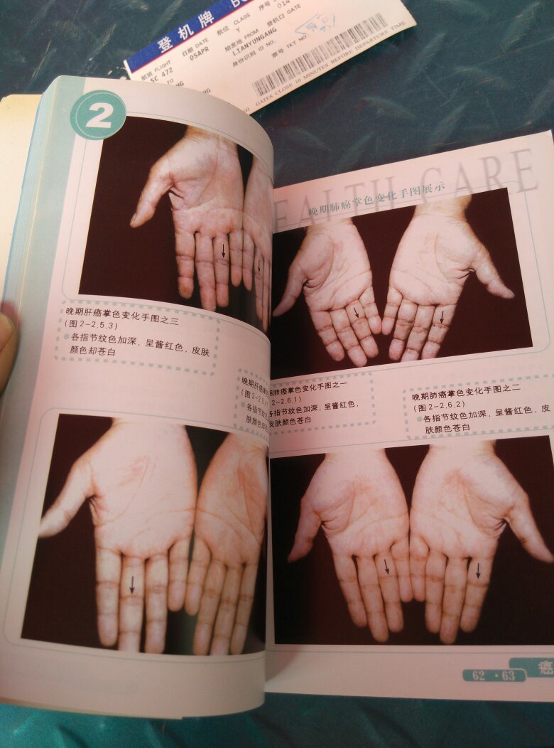 癌症看掌纹.