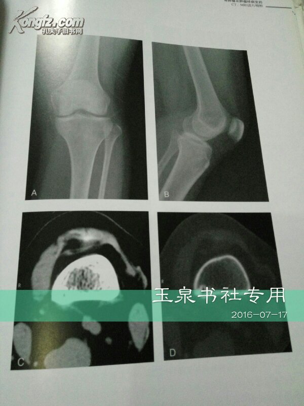 骨肿瘤及肿瘤样病变的ct,mri读片精粹