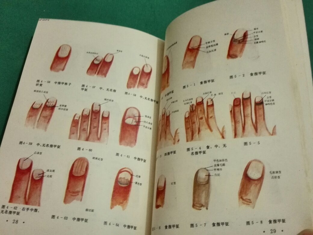 指甲诊病彩色图谱