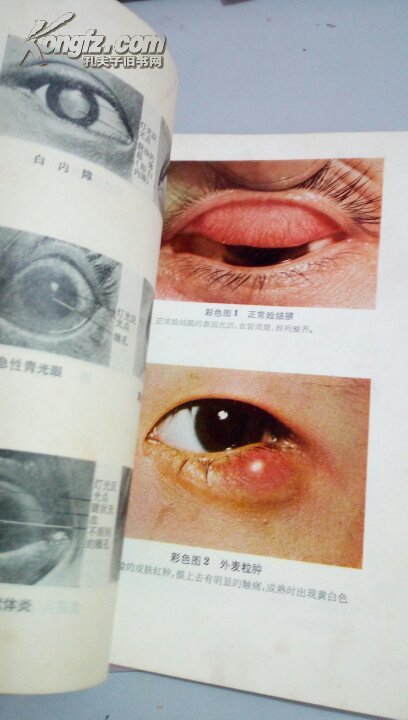 173 常见眼病的防治 彩色插图 上海第二医学院附属新华医院眼科 上海