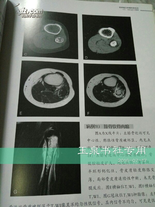 骨肿瘤及肿瘤样病变的ct,mri读片精粹