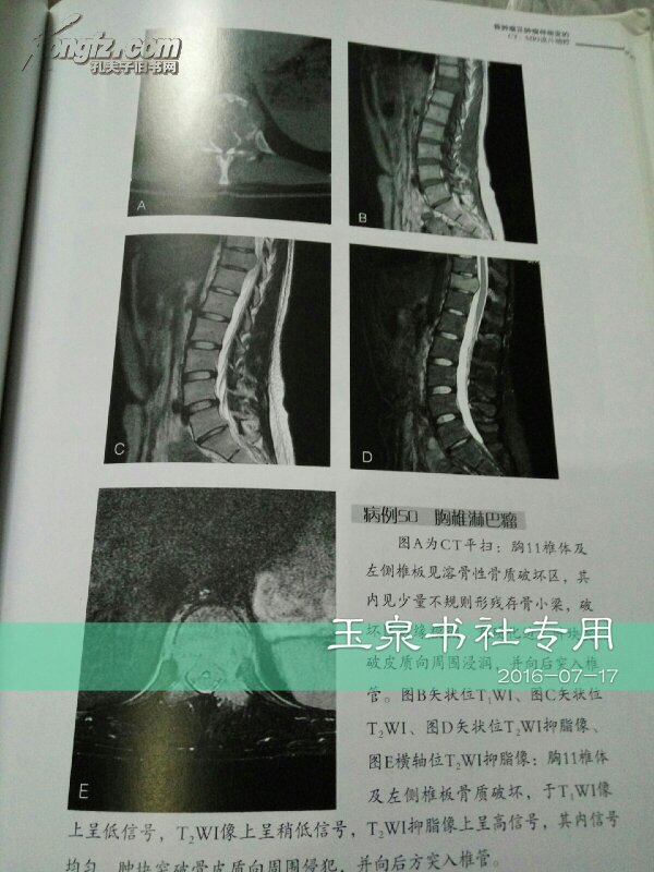 骨肿瘤及肿瘤样病变的ct,mri读片精粹