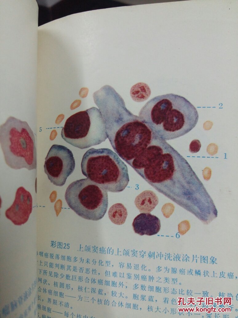 恶性肿瘤细胞检验【带语录,细胞彩色图象】
