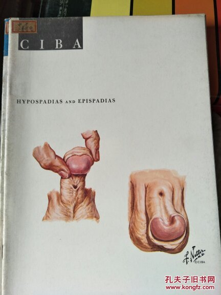 spadias and Epispadias 尿道下裂和尿道上裂(