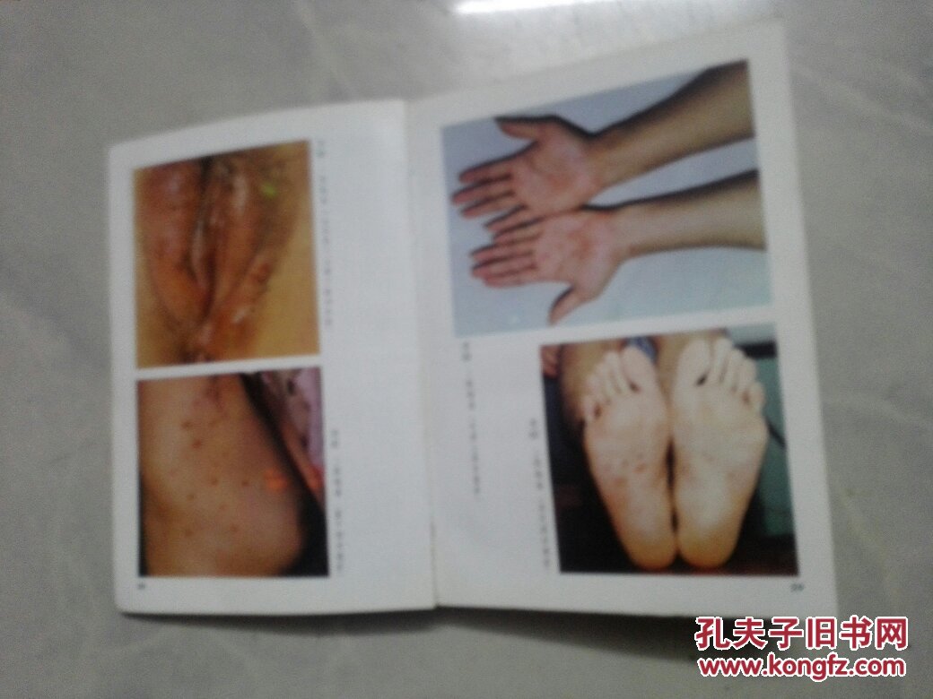 实用皮肤病性病验方精选