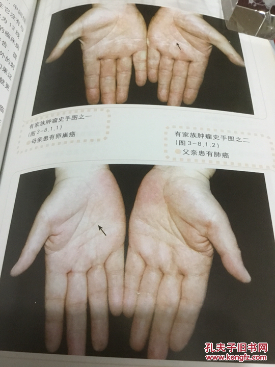 癌症看掌纹 一版一印>