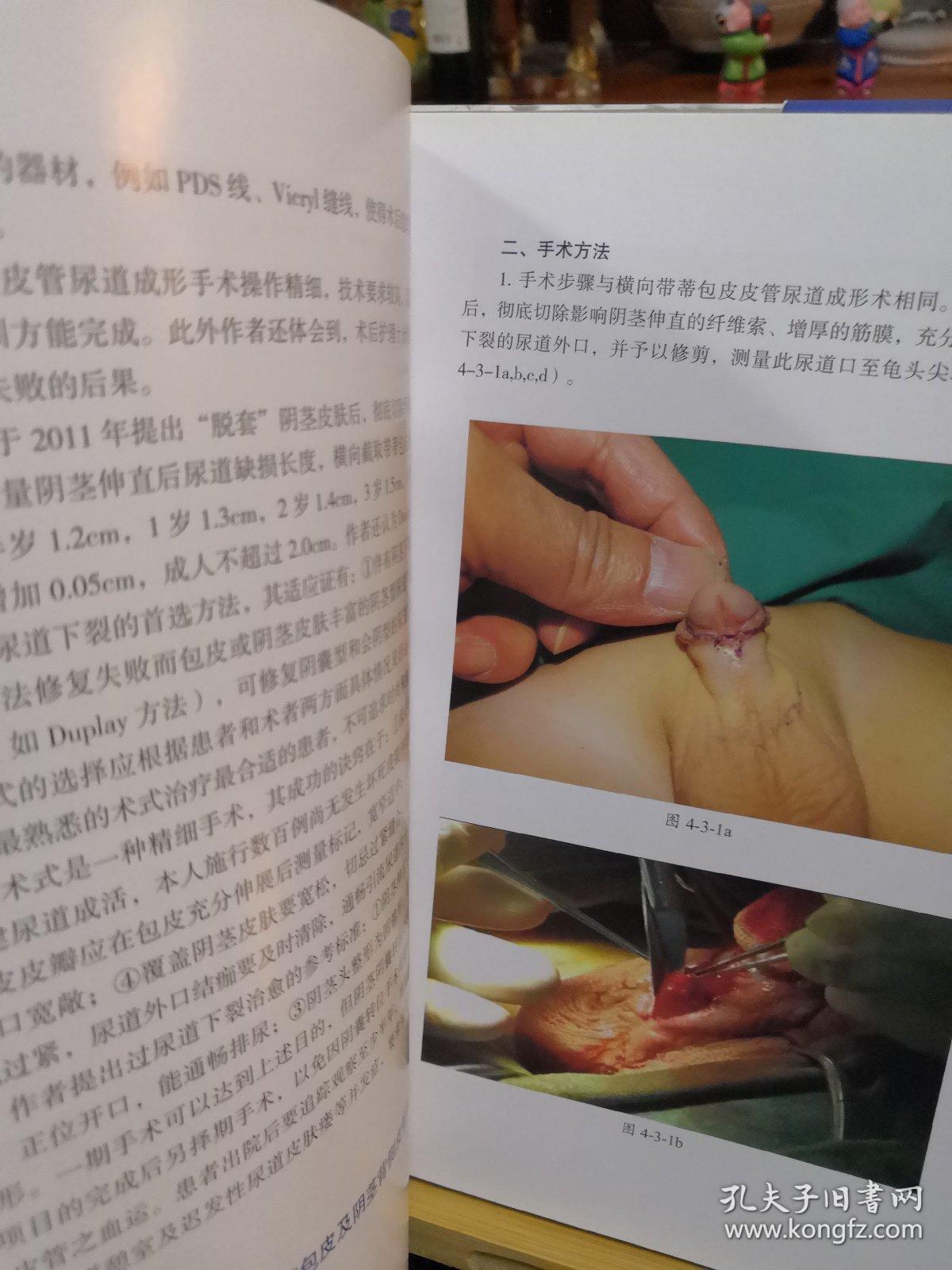 蒋先镇尿道下裂手术学