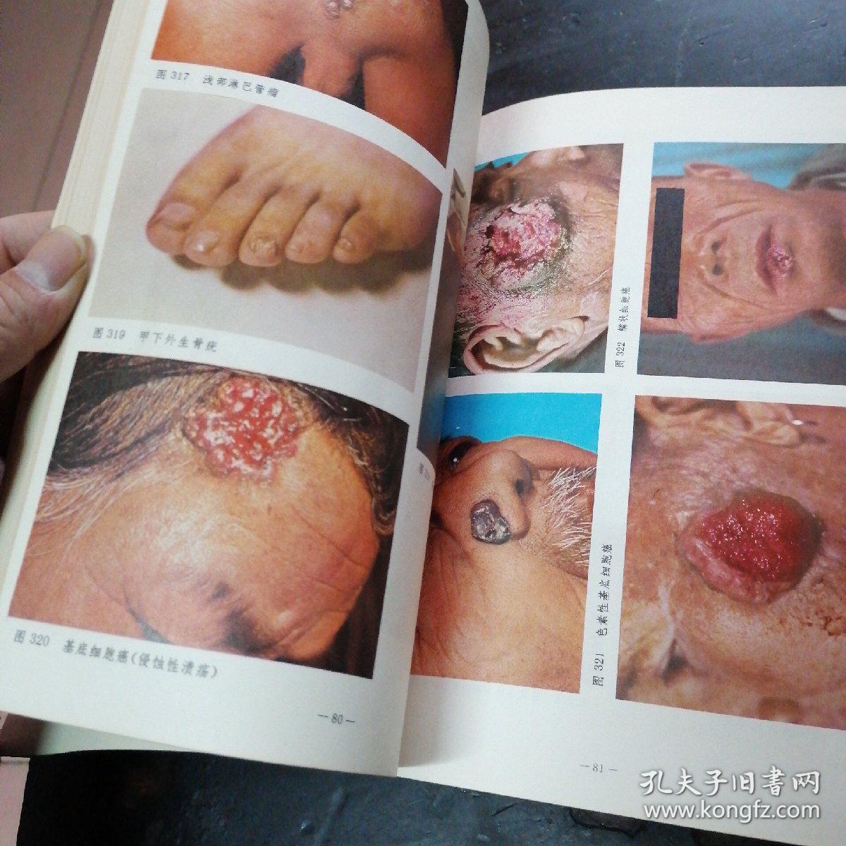 常见皮肤病,彩色图谱