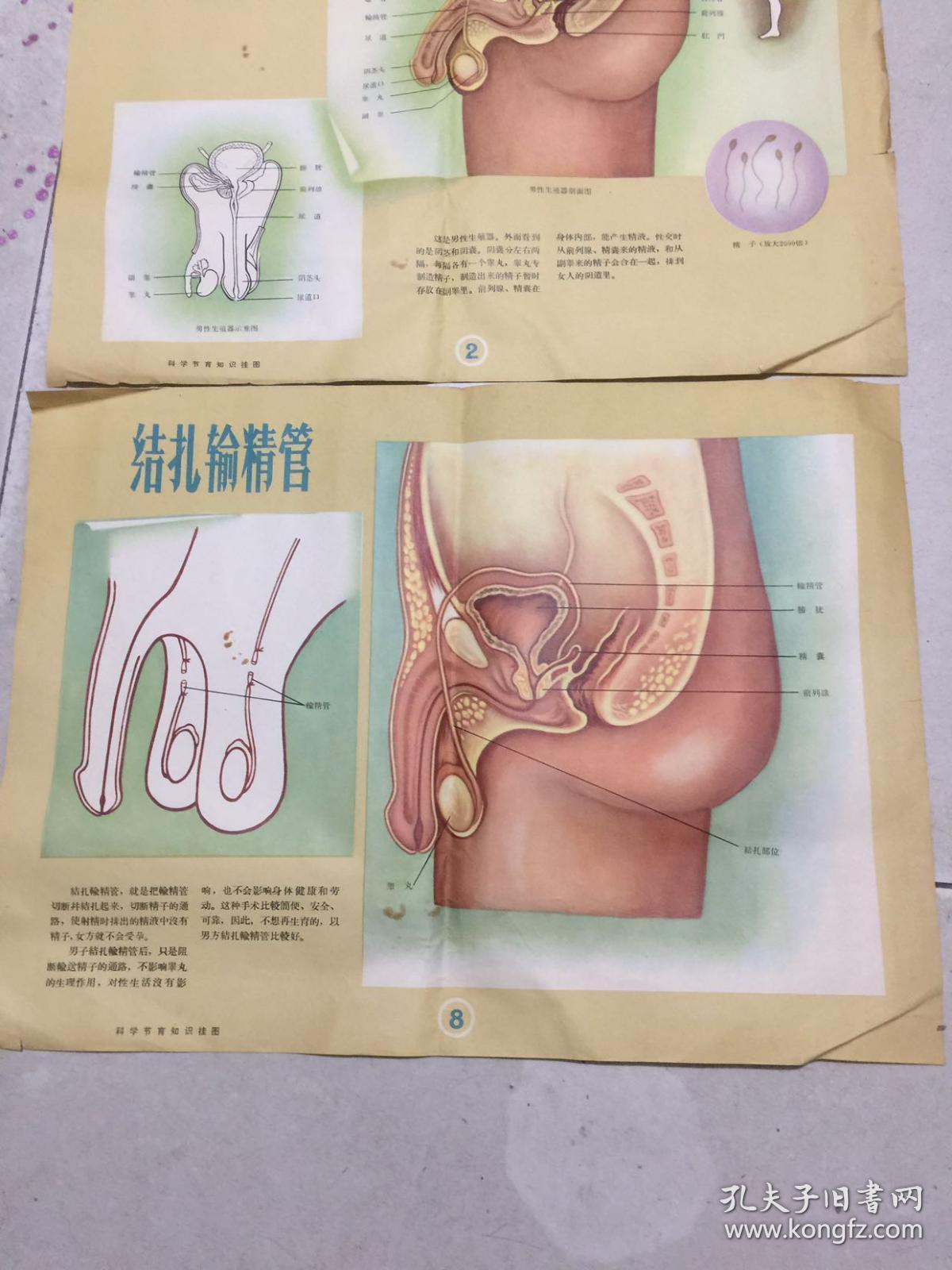 50年代 男性生殖器,结扎输精管 挂图2张
