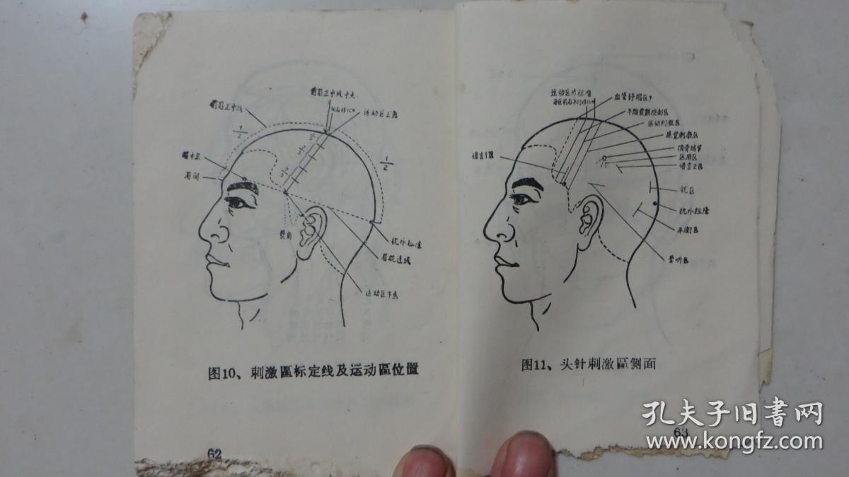 头针疗法