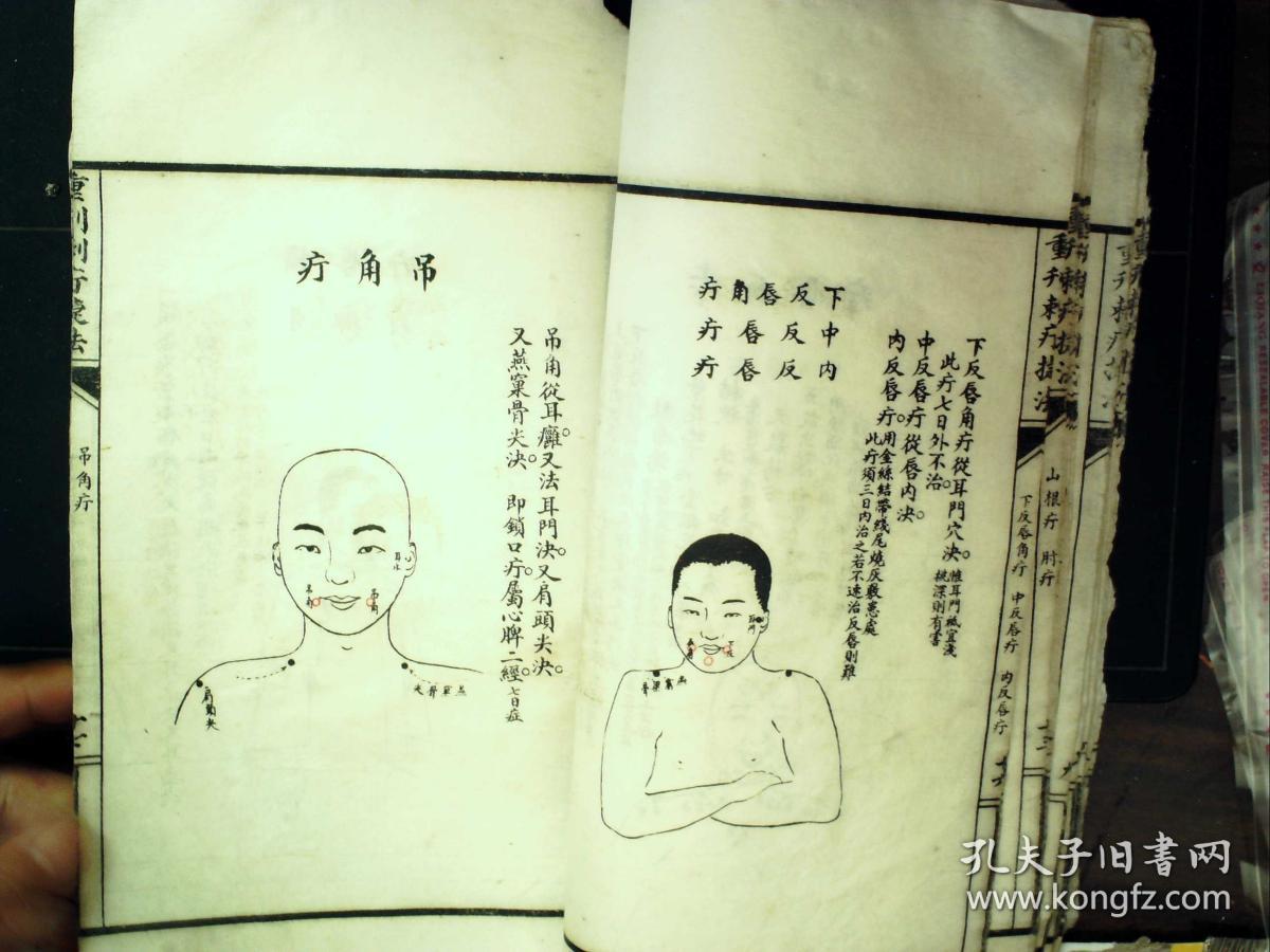 q1338少见套印本医学古籍民国白纸精美套印本重刊刺疔捷法大全大开本