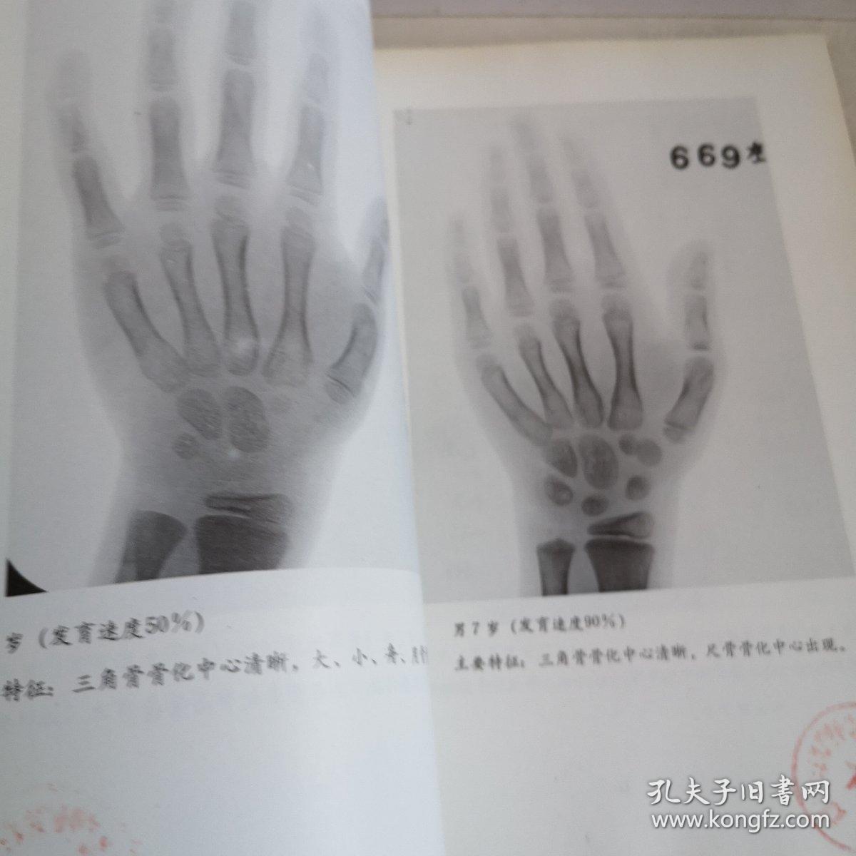 手腕部骨发育图谱(馆藏书)
