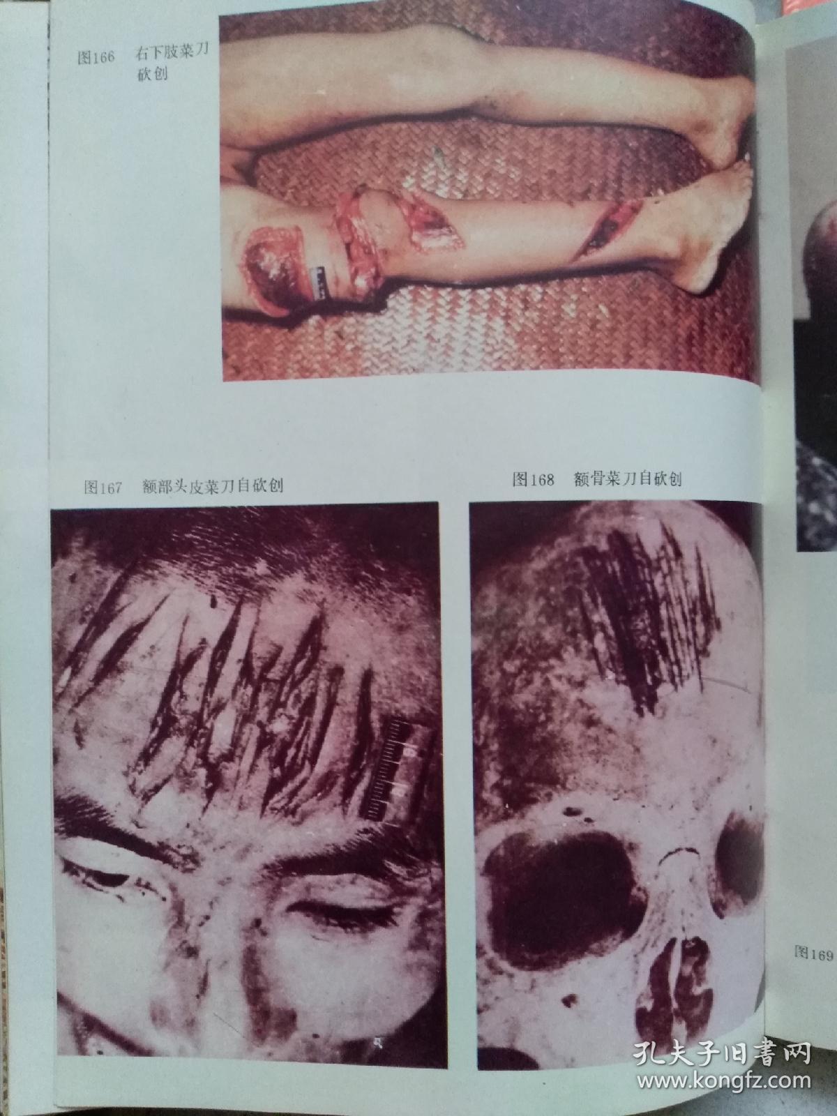 法医学彩色图谱(精装本如图)