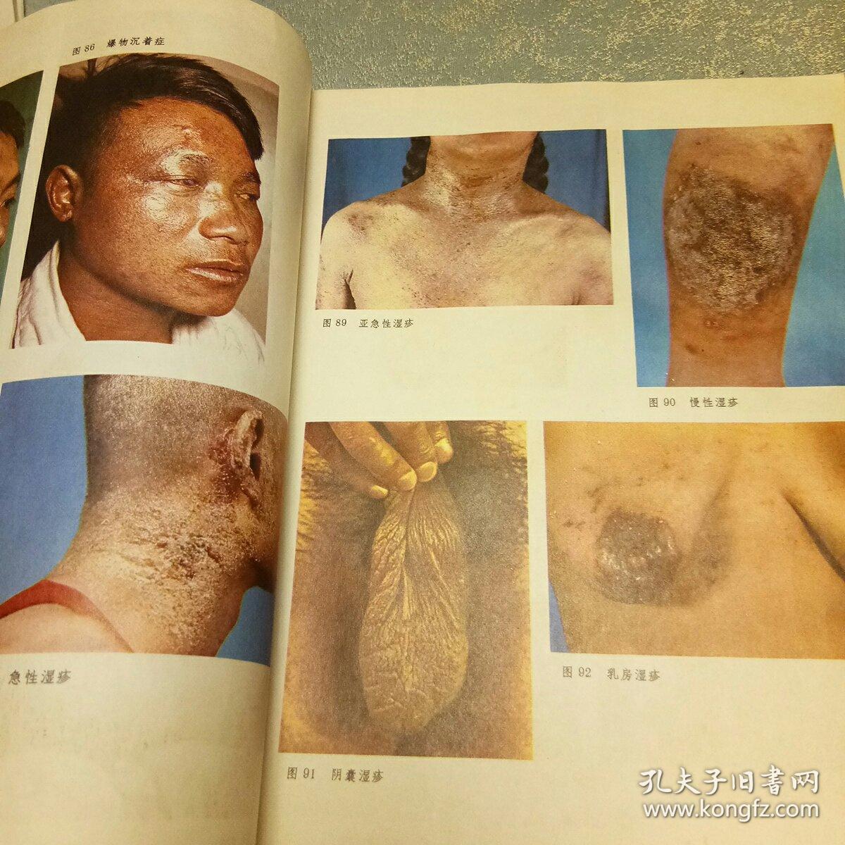 常见皮肤病彩色图谱
