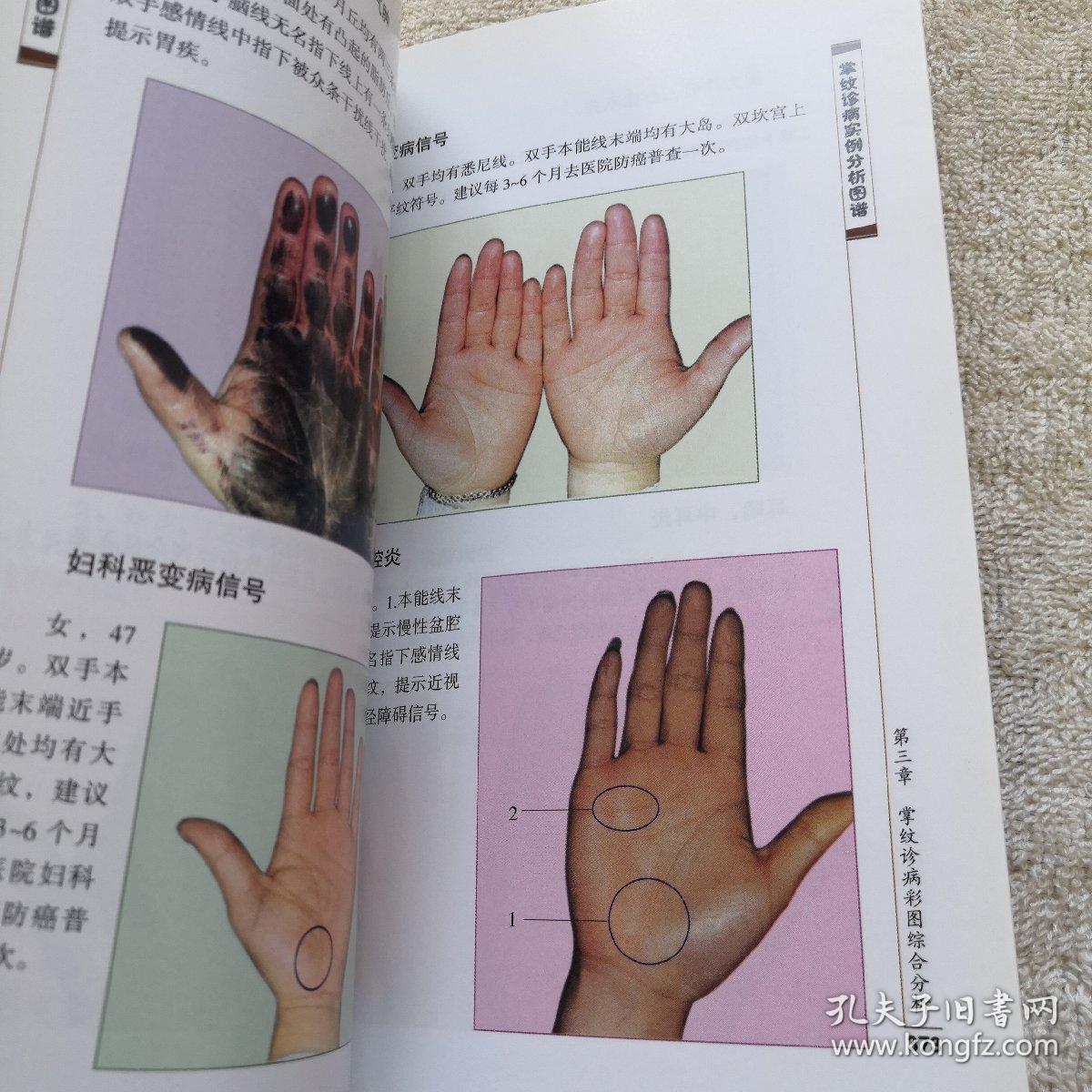 掌纹诊病实例分析图谱