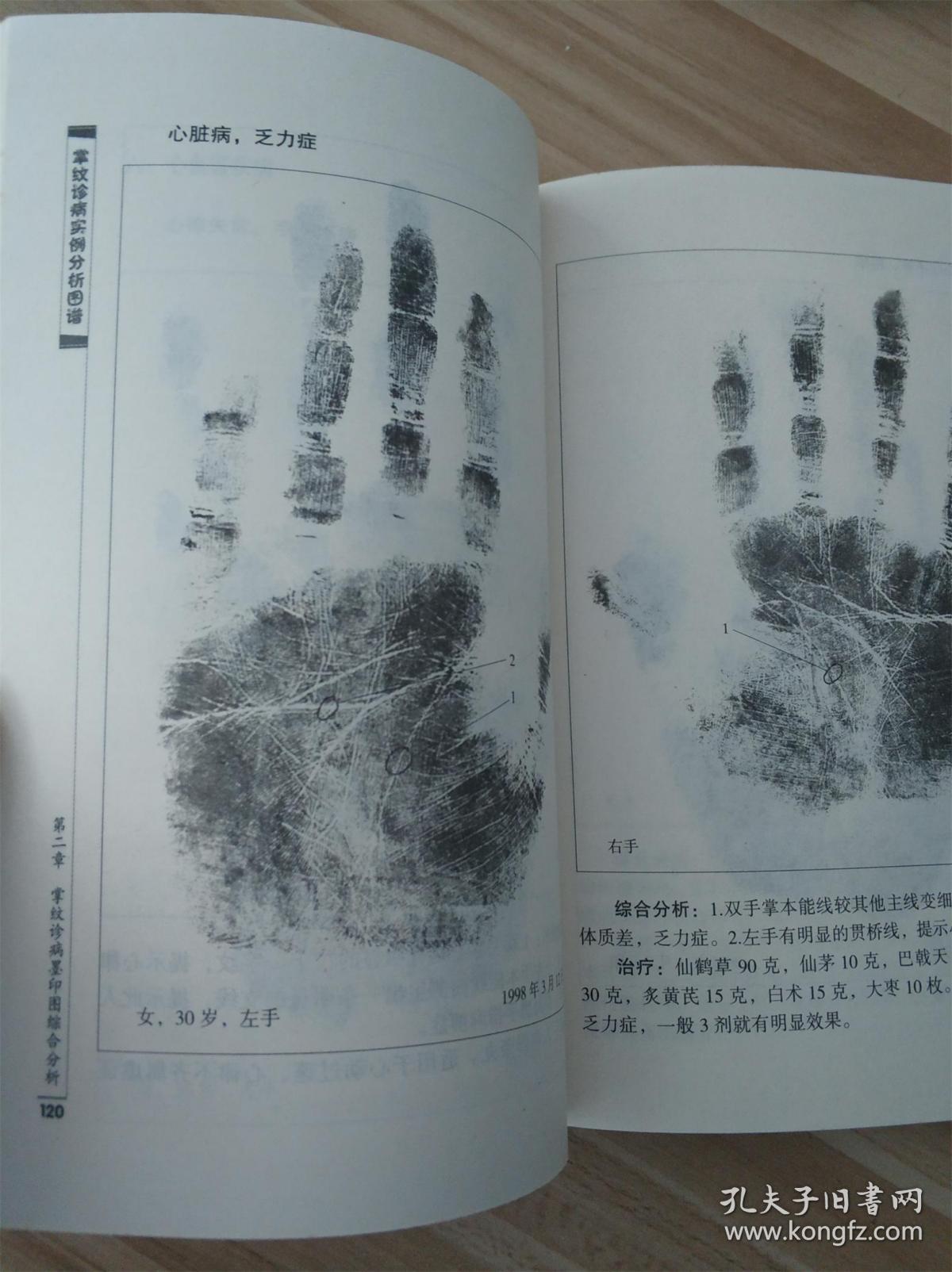 掌纹诊病实例分析图谱
