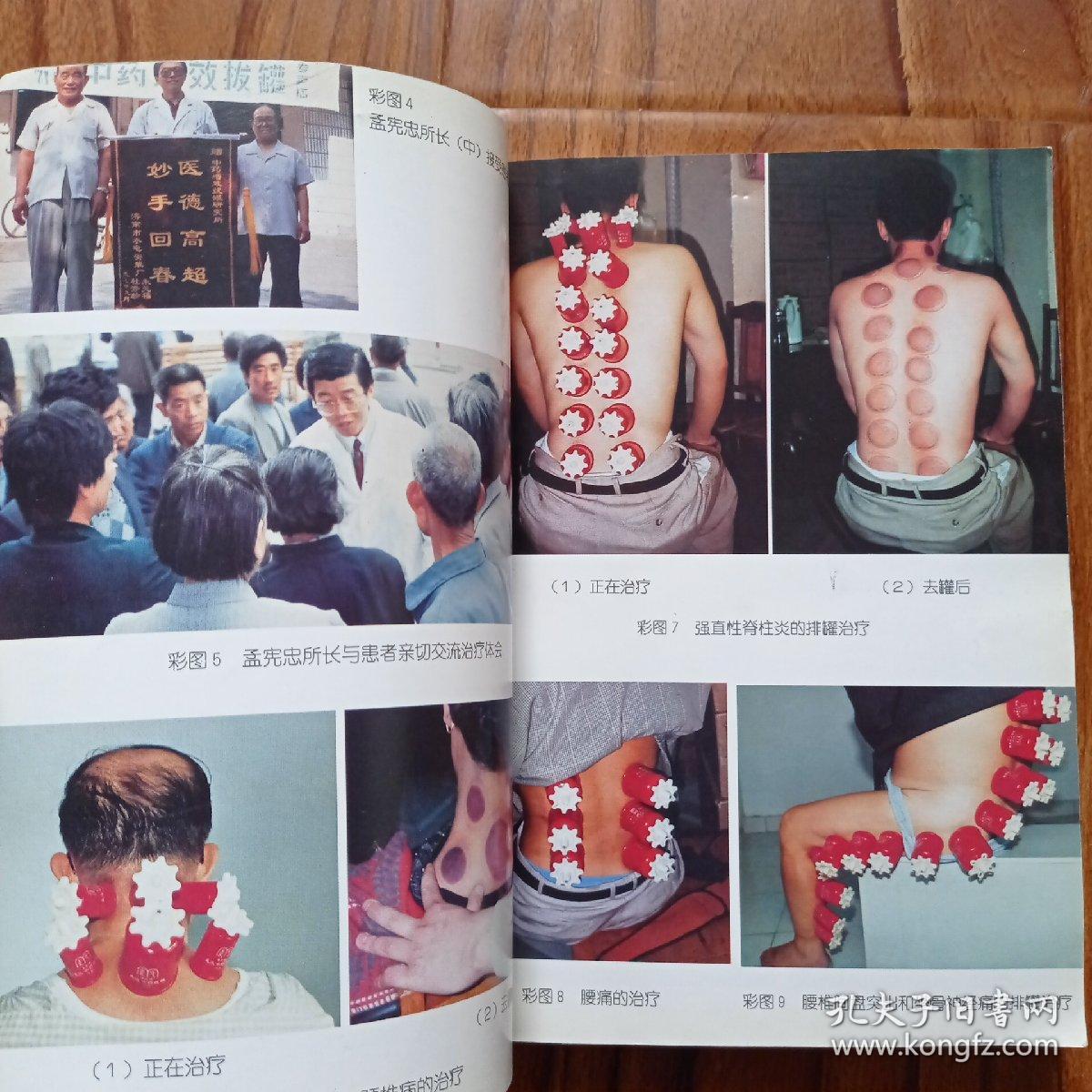 孟氏中药拔罐疗法