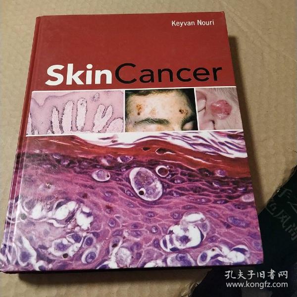 skincancer
