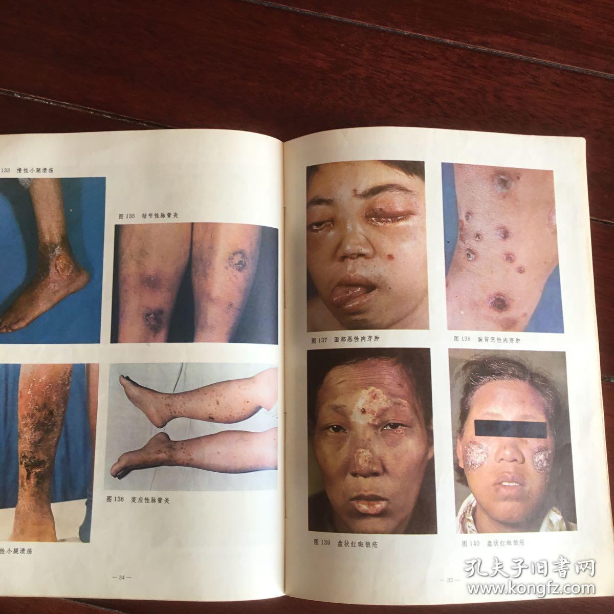 常见皮肤病彩色图谱 78年1版1印 插页47