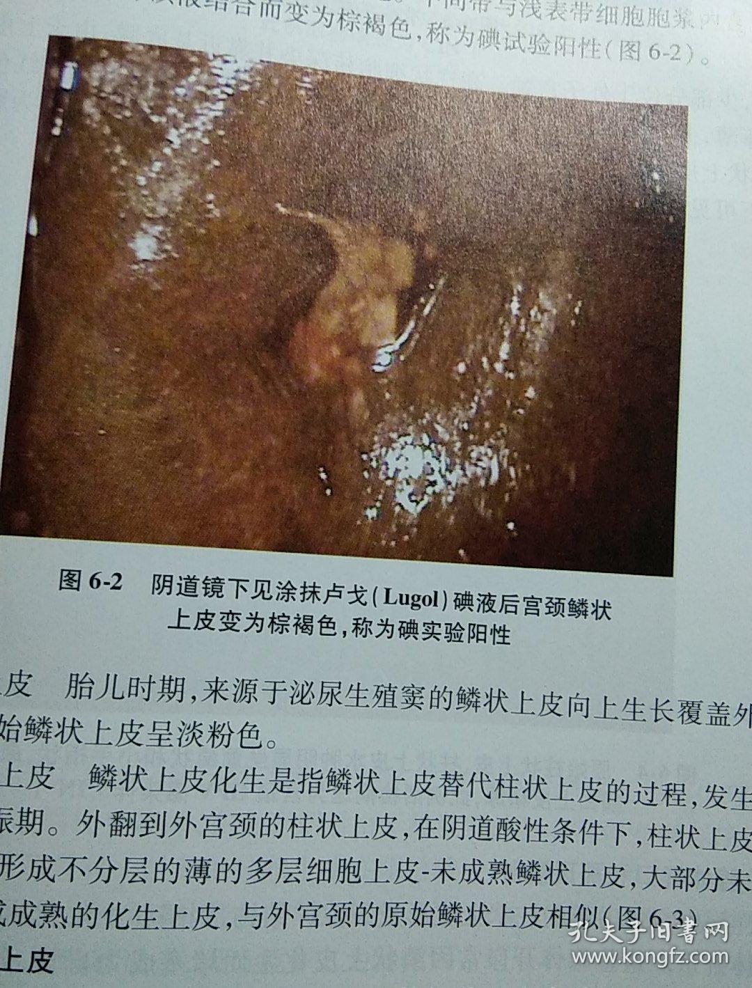 宫颈病变与宫颈癌子宫颈癌综合防控技术培训教程附彩图2本