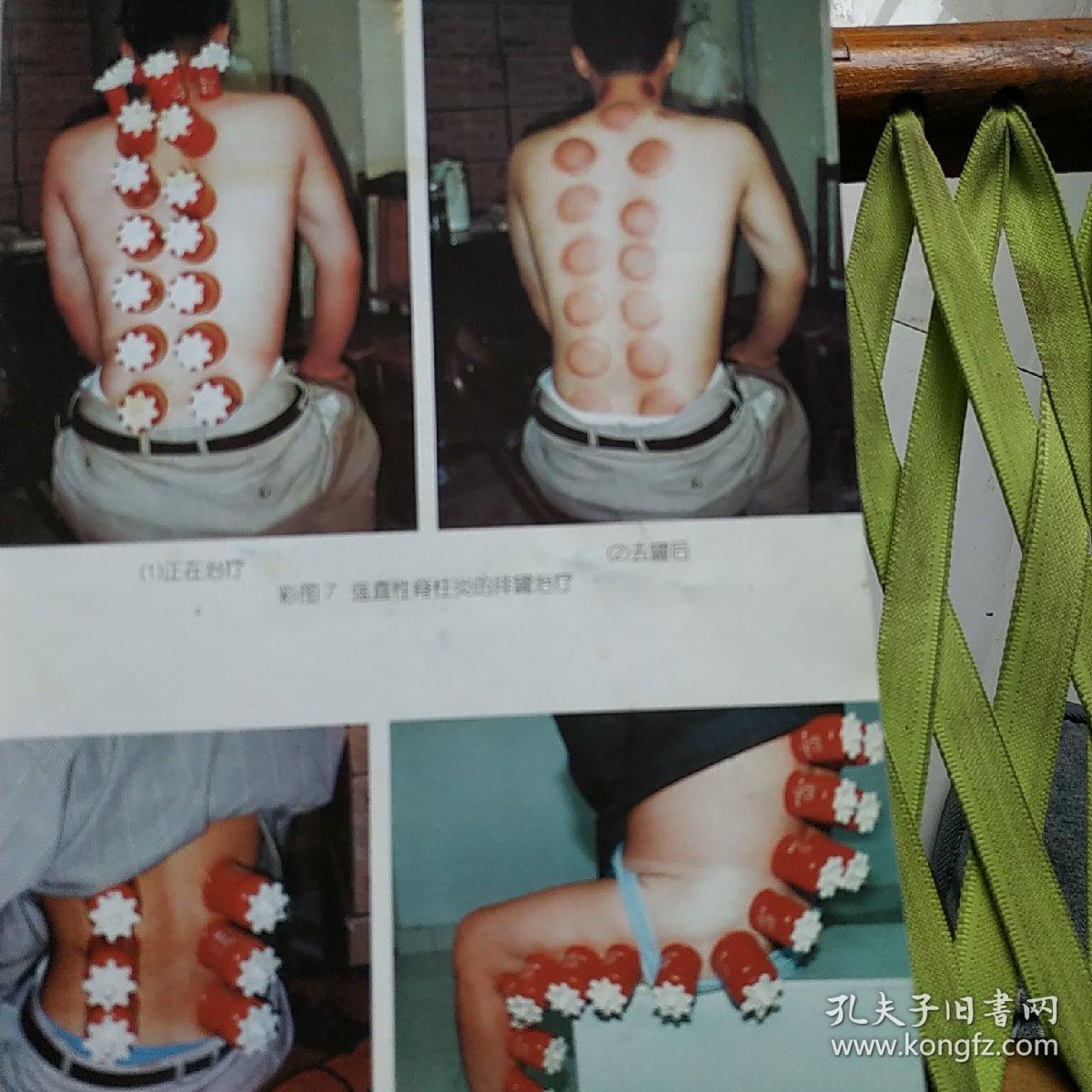 孟氏中药拔罐疗法