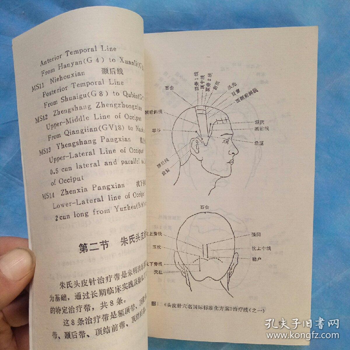 中医头皮针