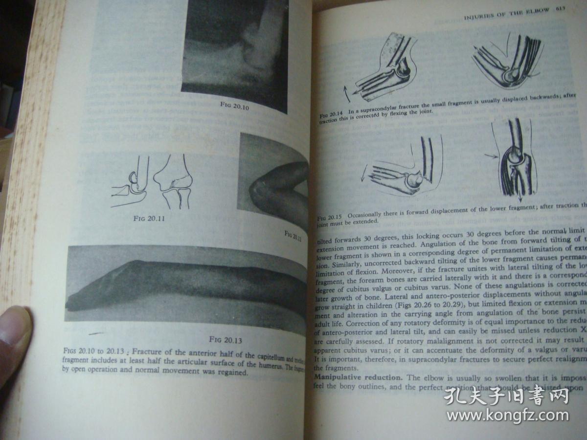 fractures and joint injuries vol 1 and vol 2 沃森-琼斯骨折与关节