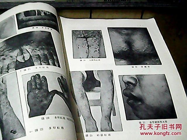 b3;皮肤花柳病学图谱【黑白图片】