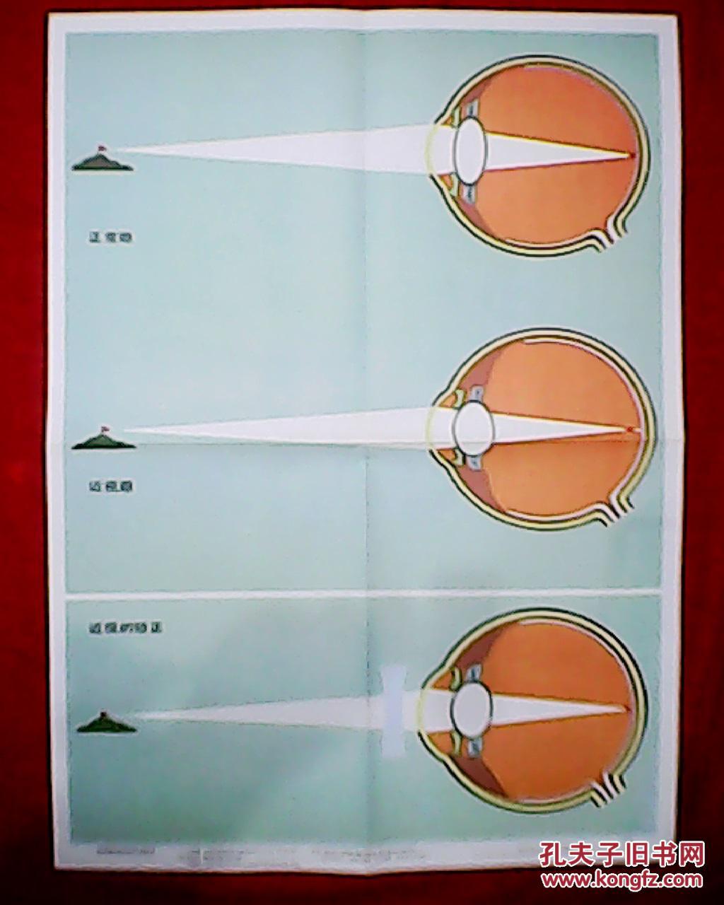 老画家杨邦鸿绘的教学挂图:近视眼的成因及其矫正(此为对开图,宽53
