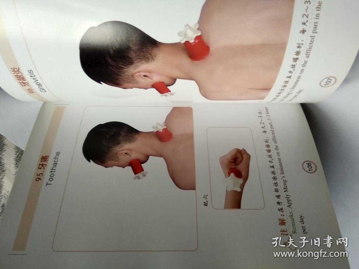 看图拔罐【孟氏拔罐疗法,中英对照】彩色图片_孟宪忠_孔夫子旧书网