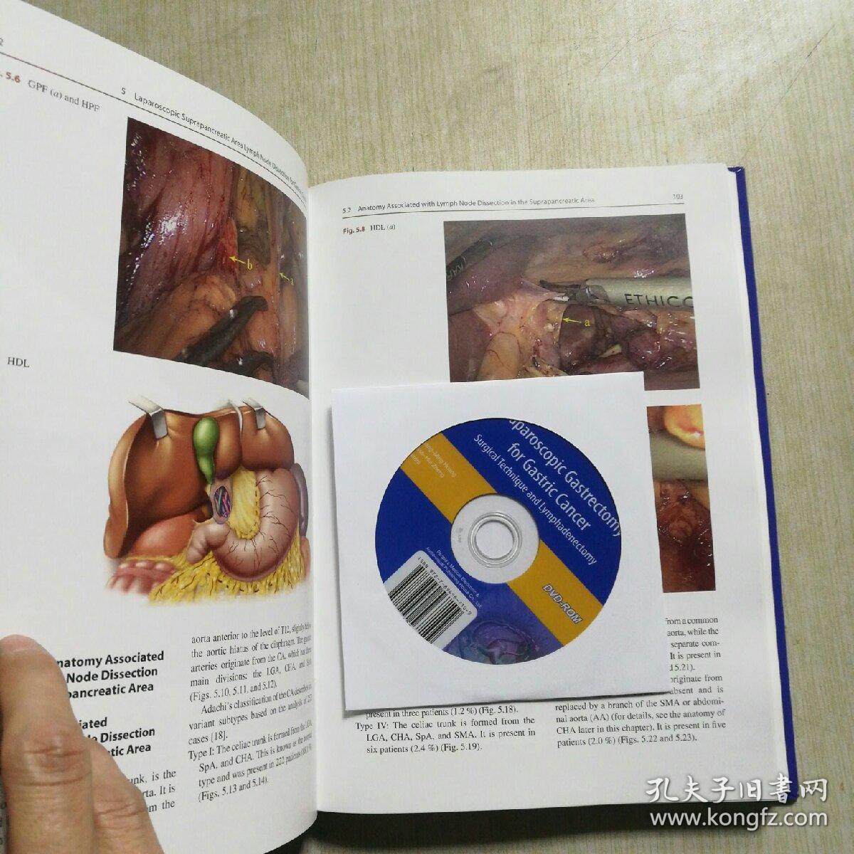 laparoscopic gastrectomy for gastric cancer: surgical technique