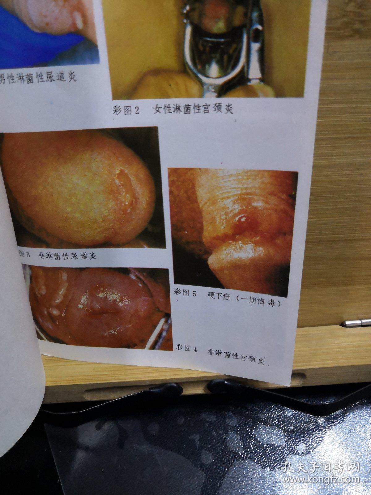 性病的中西医诊治