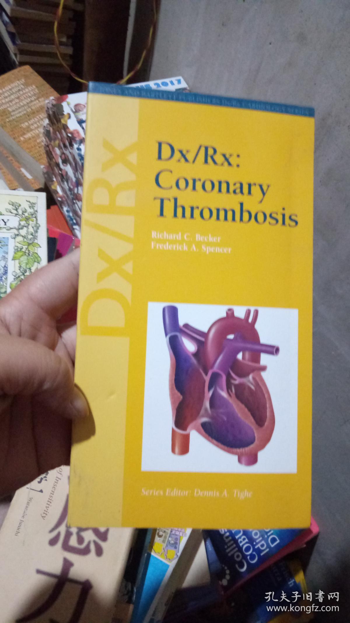 dx/rx: coronary thrombosis