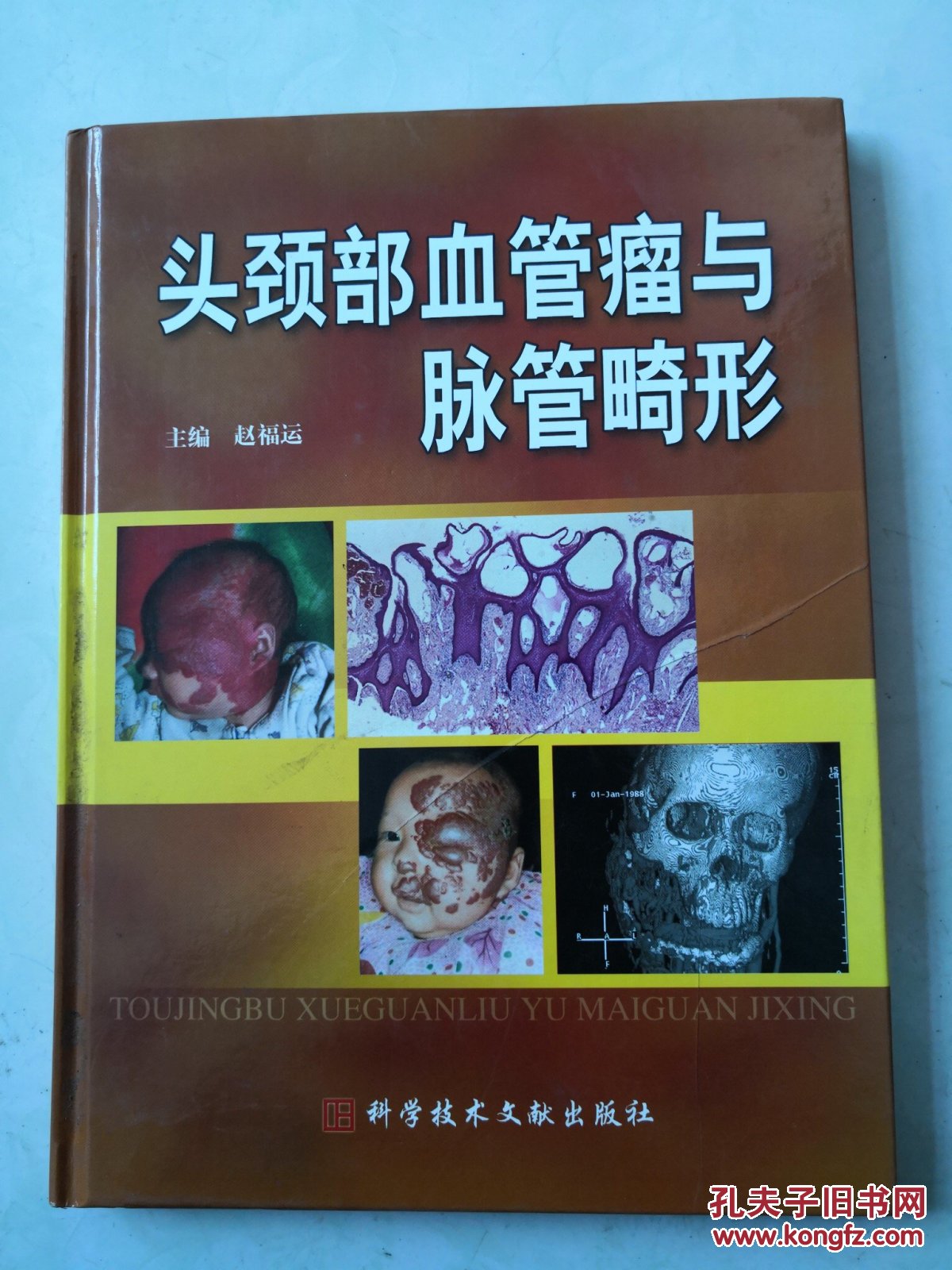 头颈部血管瘤与脉管畸形
