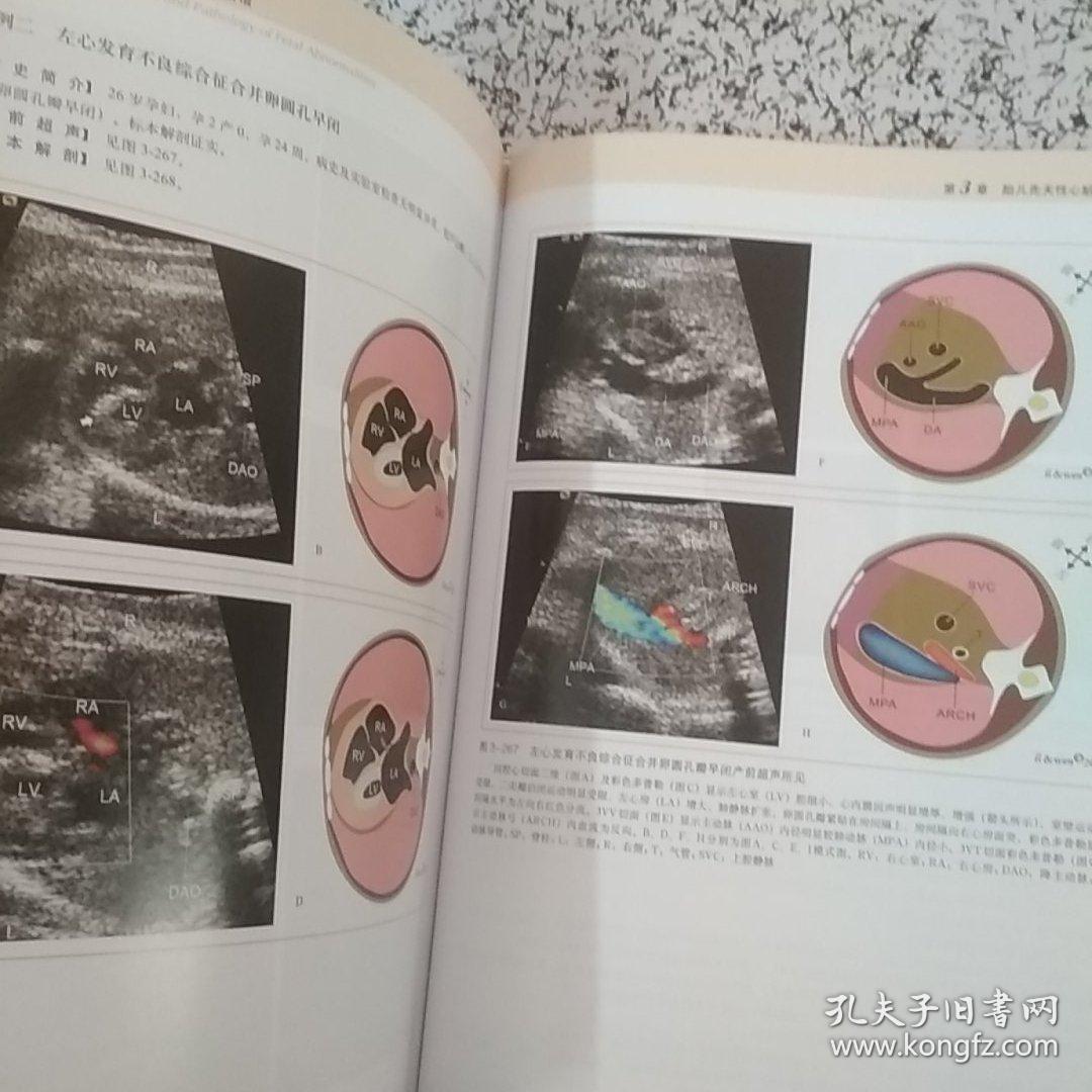 胎儿畸形产前超声与病理解剖图谱:胸腔,心脏和腹部分卷