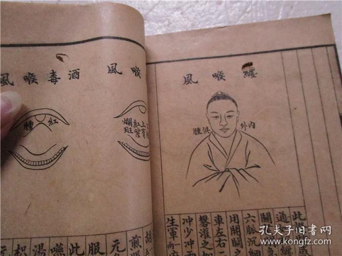 民国庚申年线装本 《烂喉丹痧辑要 》《详图喉科秘錀》上下卷 合为一