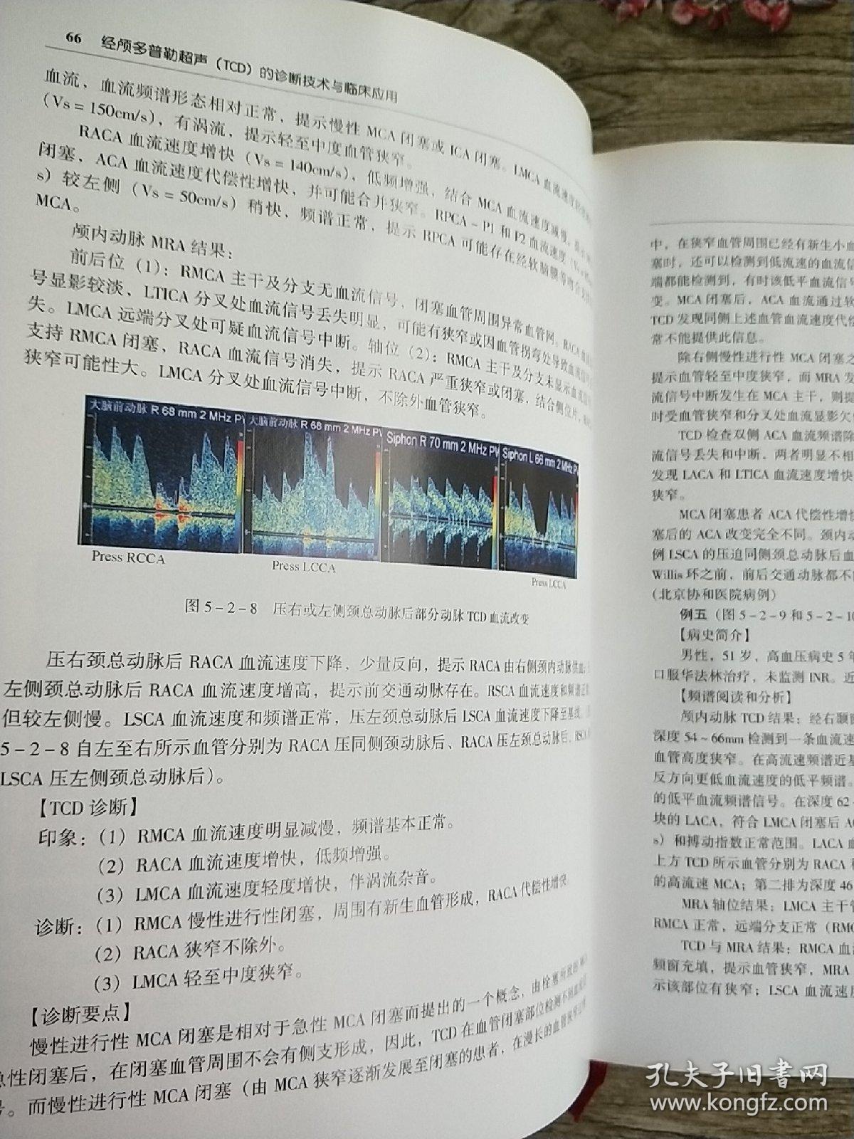 经颅多普勒超声(tcd)的诊断技术与临床应用