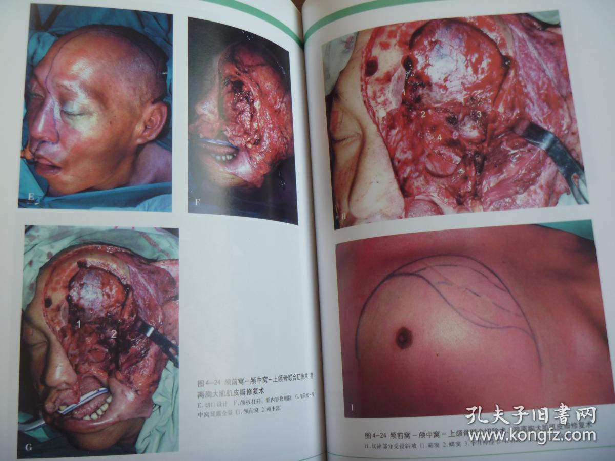 口腔颌面肿瘤手术彩色图谱