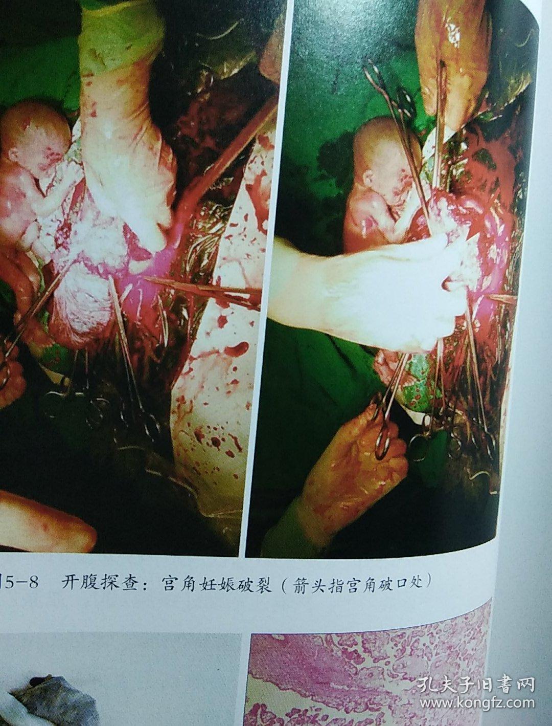 复发性流产异位妊娠诊断与治疗