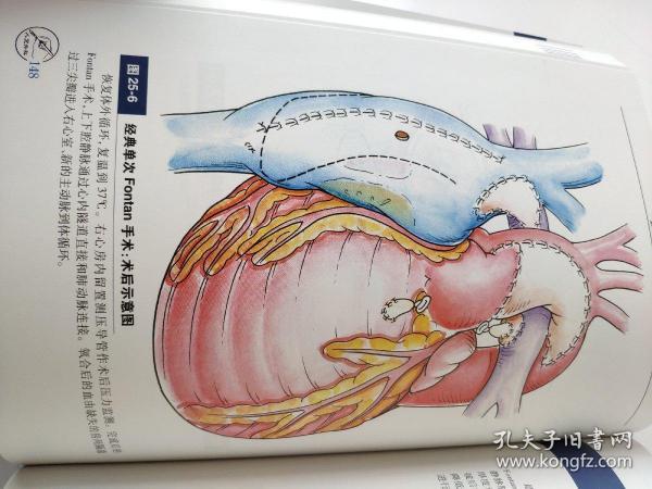 外科治疗历史,各种手术的演变和目前标准的分期改良fontan手术;第二